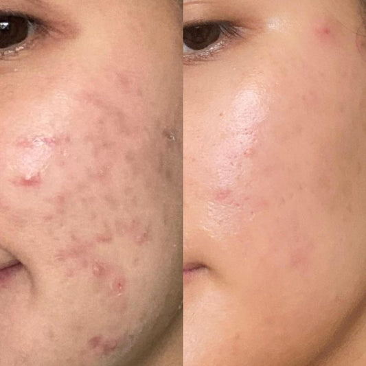Facial Steamer for Spa-Like Skin Treatment at Home