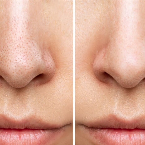 Water Tank Blackhead Remover Device for Clear Skin
