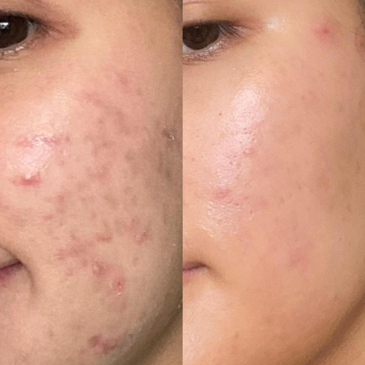 Facial Steamer for Spa-Like Skin Treatment at Home