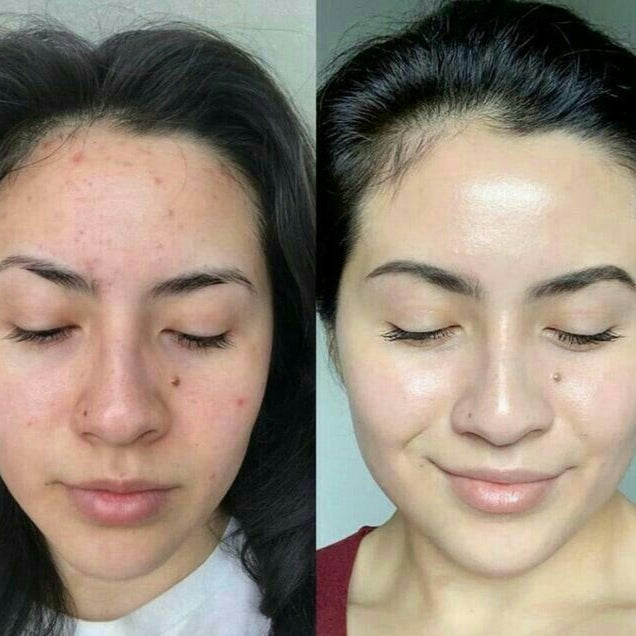 Facial Steamer for Spa-Like Skin Treatment at Home